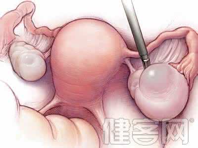 卵巢囊肿会影响生育吗 卵巢囊肿会影响生育 卵巢囊肿会影响生育吗