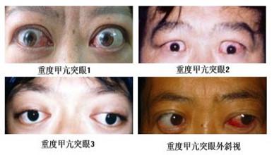 甲亢突眼怎么治疗 甲亢突眼 怎么治疗甲亢突眼