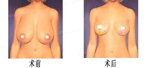 乳房缩小手术多少钱 乳房缩小手术多少钱 常用沐浴乳房易缩小 6招助女人呵护乳房