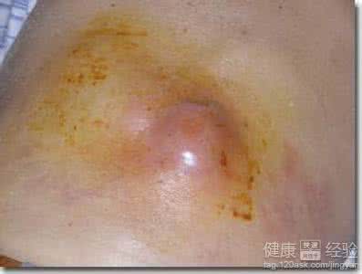 中医治疗疱疹会好 疱疹的中医治疗是怎样的