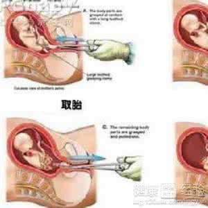 伤害最小的堕胎方法 堕胎的危害有哪些