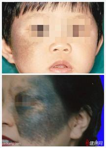 怎样消除脸上的太田痣 太田痣是怎样发生的？