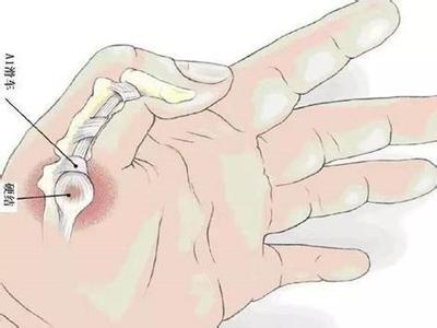 中华医药骨质疏松 《中华医药》推割松解“扳机指”（腱鞘炎）