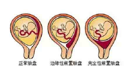 吃羊胎盘时的注意事项 吃胎盘的注意事项有哪些