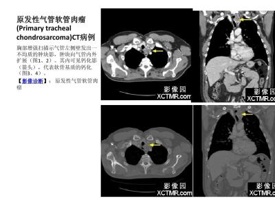 肿瘤影像学 影像学对胸部肿瘤的诊断