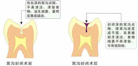 乳牙需要做窝沟封闭吗 “窝沟封闭”并非人人都需要