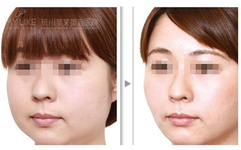 吸脂瘦脸过程 吸脂瘦脸过程 解析吸脂瘦脸全过程