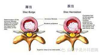 腰椎间盘脱出与突出 腰椎间盘膨出、突出、脱出？教你一招搞定！！