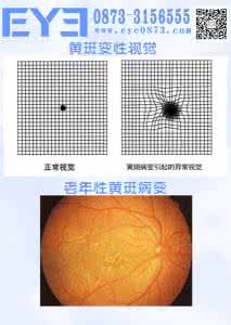 黄斑变性的治疗方法 黄斑变性 早期发现黄斑变性的自检法