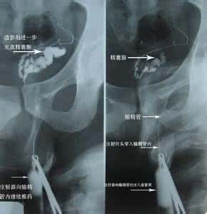 非梗阻性无精子症 非梗阻性无精子症 梗阻性无精子症 可以治愈的病