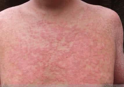 春天手上长湿疹奇痒 图文：湿疹奇痒，神水除根