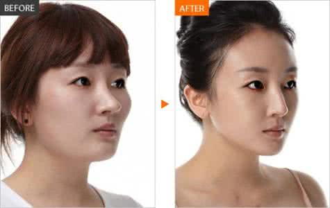 韩国隆鼻术 韩国隆鼻术 韩国隆鼻术的特点有哪些