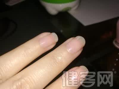 指甲型银屑病 指甲型银屑病 什么是指甲银屑病？