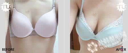 隆胸疤痕 隆胸 隆胸疤痕