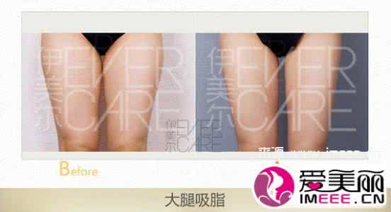 吸脂手术每部位多少钱 吸脂手术每部位多少钱 吸脂一个部位多少钱