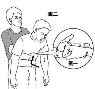 海姆里克腹部冲击法 人人都要掌握“海姆里克”法
