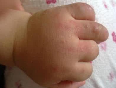 季节性皮肤过敏湿疹 季节性皮肤过敏湿疹 季节皮肤过敏怎么办 怎么样远离过敏