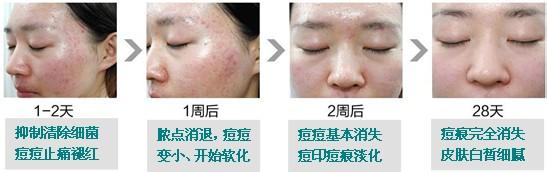 治疗痘痘的最好方法 治疗痘痘的方法具体有哪些