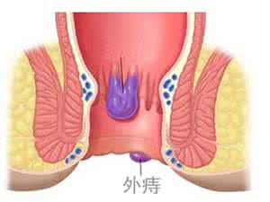 外痔的症状有哪些 外痔的症状 有这症状小心是外痔