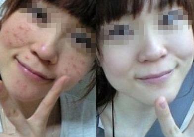 红痘痘怎么紧急祛痘 红痘痘怎么紧急祛痘 过年回家相亲，痘痘挡你桃花运，一招教你祛痘