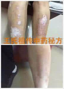 咽喉炎最佳治疗方法 治疗牛皮癣 这些方法能治牛皮癣