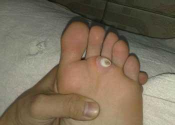 治脚鸡眼的最好办法 脚鸡眼怎么治 可以治好吗