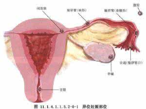 残角子宫妊娠 残角子宫妊娠 宫外孕之子宫残角妊娠及卵巢妊娠