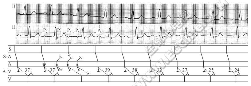 窦性异位心律 室上性异位搏动 房性异位搏动揭示窦性并行心律