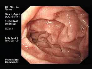 摩罗丹治疗萎缩性胃炎 摩罗丹治疗萎缩性胃炎效果好吗？