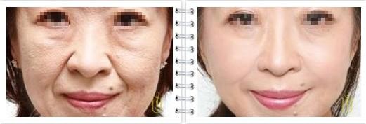 内窥镜面部除皱术 内窥镜面部除皱术 除皱术之内窥无创除皱