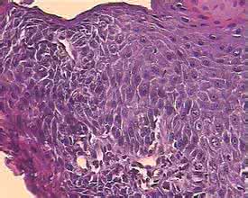 尖锐湿疣 尖锐湿疣最好的治疗方法
