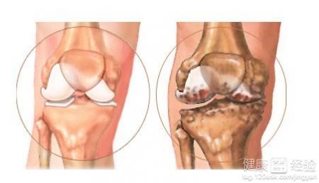 膝关节骨质增生怎么办 膝关节骨质增生 膝关节骨质增生怎么处理