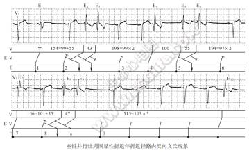 慈悲 路内 路内 慈悲txt 室性并行灶周围显性折返伴折返径路内反向文氏现象心电图精解