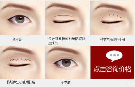 双眼皮埋线能保持多久 埋线双眼皮能保持多久 做埋线双眼皮能保持多久