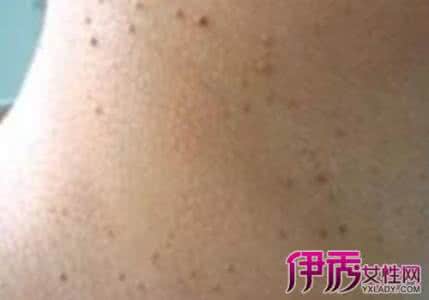 脖子上长小肉疙瘩 脖子 肉疙瘩 去除 脖子上长小肉疙瘩怎么办 如何去除小肉疙瘩