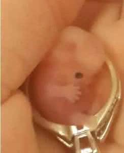 两次胎儿畸形 她两次流产,竟把胎儿做成这个东西……