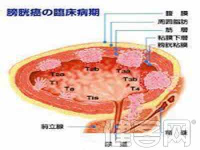 膀胱癌生存期 膀胱癌能活多久 如何延长膀胱癌生存期