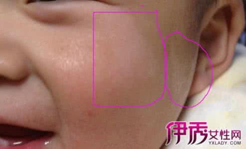 白斑的发病原因有哪些 白斑的发病原因有哪些 白线疝 它有哪些发病原因