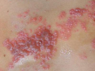 带状疱疹后遗症专用药 带状疱疹:用了30年的验方