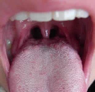 喉咙上长小肉疙瘩 喉咙上长小肉疙瘩 喉咙有肉疙瘩是什么?