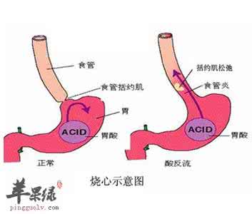 胃酸是怎么引起的 胃酸是怎么回事