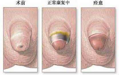 包皮炎症状 包皮手术后的注意事项