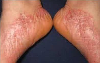 脚后跟干裂用什么涂抹 脚后跟干裂 脚后跟干裂，用这味中药研粉涂抹几天就见效