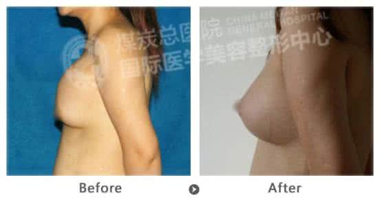 隆胸失败 隆胸失败 代表隆胸失败的几种情况