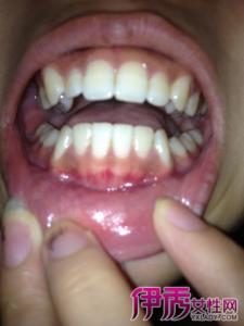艾滋病早期口腔症状 艾滋病口腔 艾滋病早期重要症状:口腔的各种表现