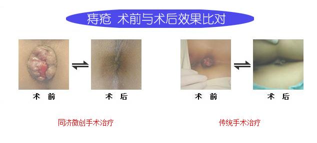 轻微痔疮怎么治疗 得了轻微痔疮怎么治疗 得了痔疮该怎么治疗