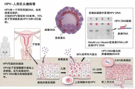 hpv治疗方法 hpv治疗方法 HPV如何治疗比较好