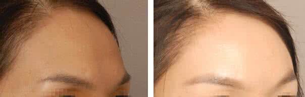 填充丰额头 填充额头材料 丰额的填充材料主要有哪些