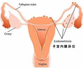 腹壁子宫内膜异位症 循证护理在腹壁切口子宫内膜异位症患者中的应用及效果评价