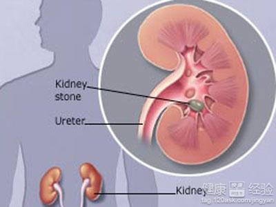 胆结石和膀胱结石 可排肾结石、膀胱结石、胆结石